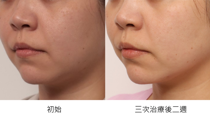 Onda Pro超微波要做幾次才有效？ 
